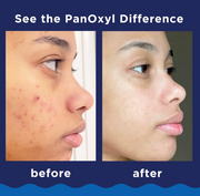 PANOXYL FOR FACE Y BODY 5.5OZ